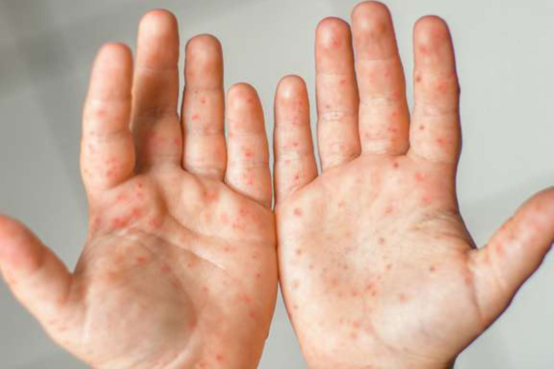 Es una enfermedad estacional y ataca a los niños pequeños con lesiones en las palmas de la mano, planta de los pies y la boca. (Foto: ANDINA/Difusión)